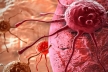 مبارزه با سلول‌های سرطان معده با فناوری نانو